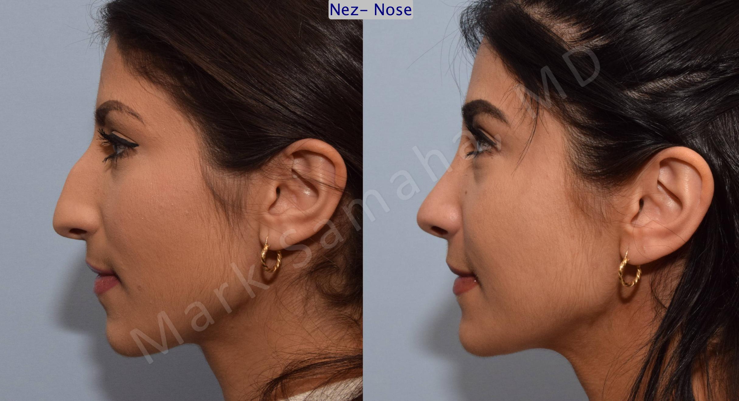 Before & After Rhinoplasty / Rhinoplastie Case 83 View #1 View in Mount Royal, QC
