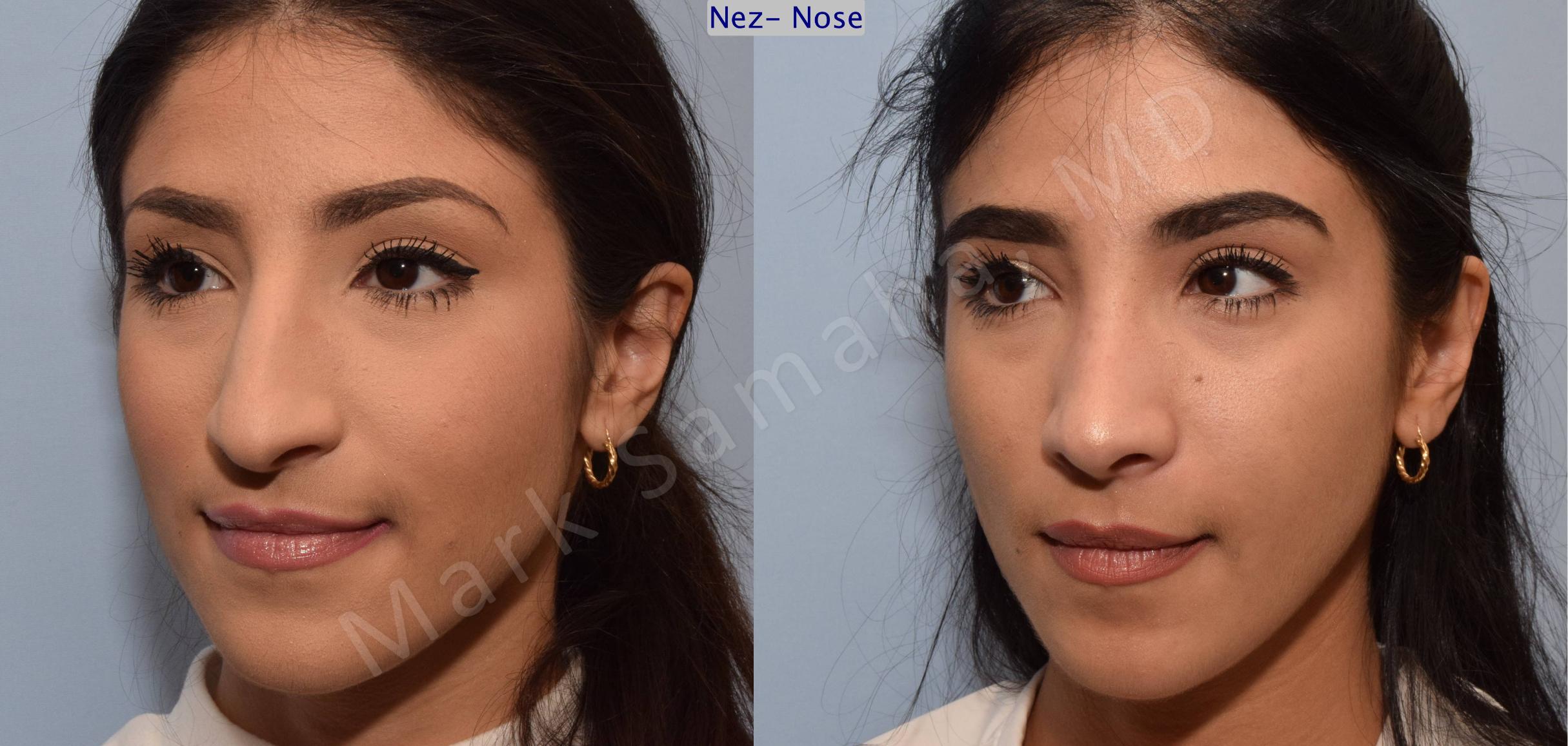 Before & After Rhinoplasty / Rhinoplastie Case 83 View #3 View in Mount Royal, QC